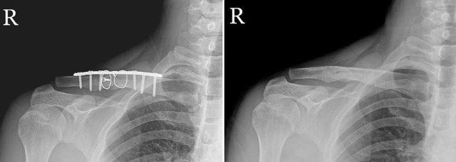 쇄골 수술 및 내고정물 제거 후.jpg