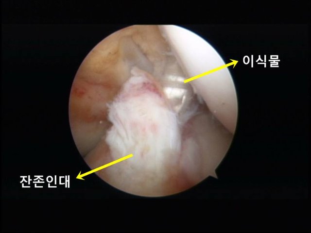 잔존인대 보존.jpg