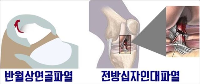 반월상연골파열, 전방십자인대파열.jpg