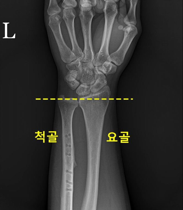 3 신복순(23052) 금속판 제거 후 1.jpg