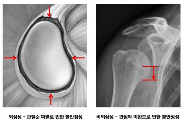 불안정성 종류.jpg