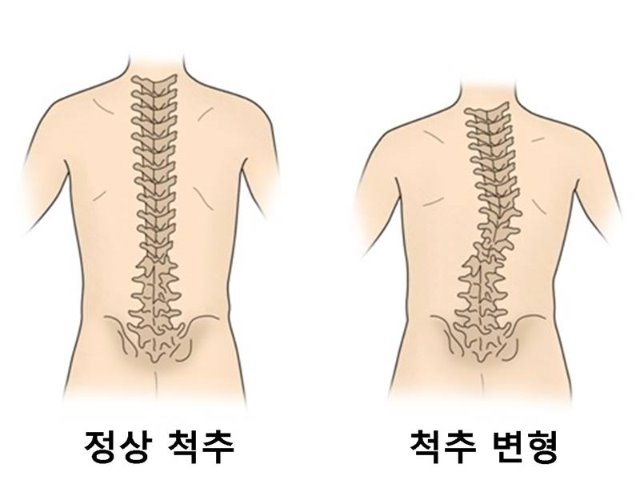 척추변형.jpg