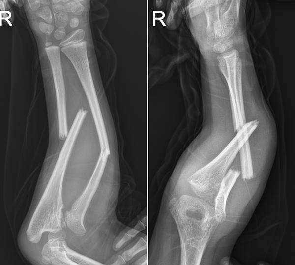 수술 전 x-ray.jpg