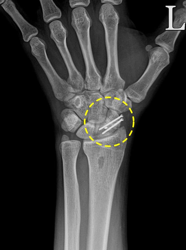 수술 후 x-ray.jpg