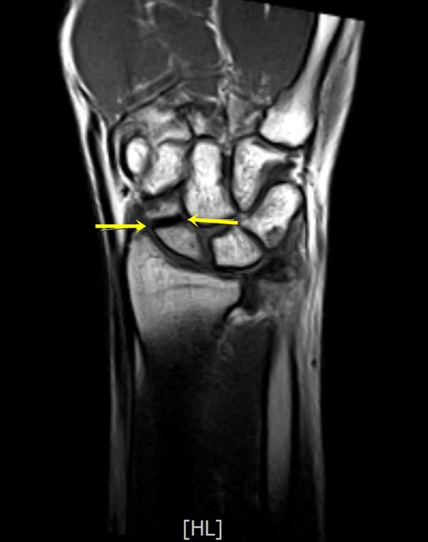 수술 전 MRI -1.jpg