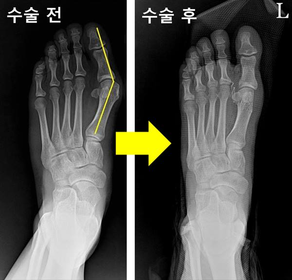 수술 전, 후 비교 x-ray.jpg