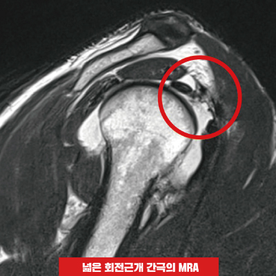 넓은-회전근개-간극.jpg