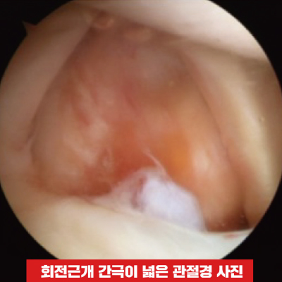 회전근개-간극이-넓은-관절경-사진.jpg