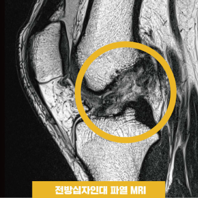 전방십자파열.jpg
