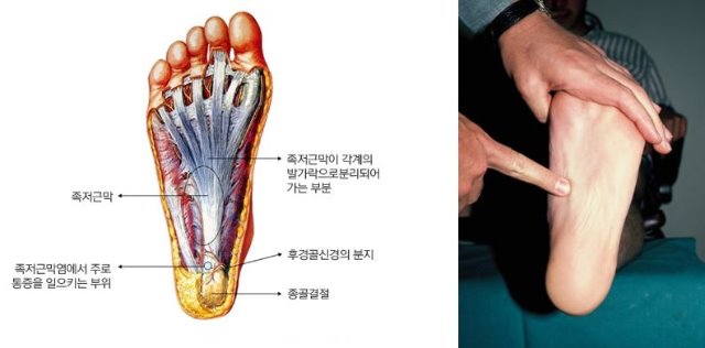 발바닥에서 본 족저근막염.JPG