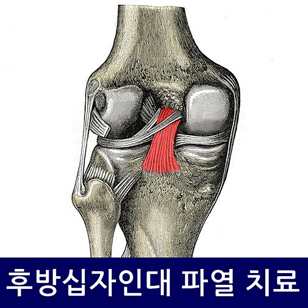 마디사랑병원 ㅣ 관절, 척추, 재활, 줄기세포 - Community > Blog