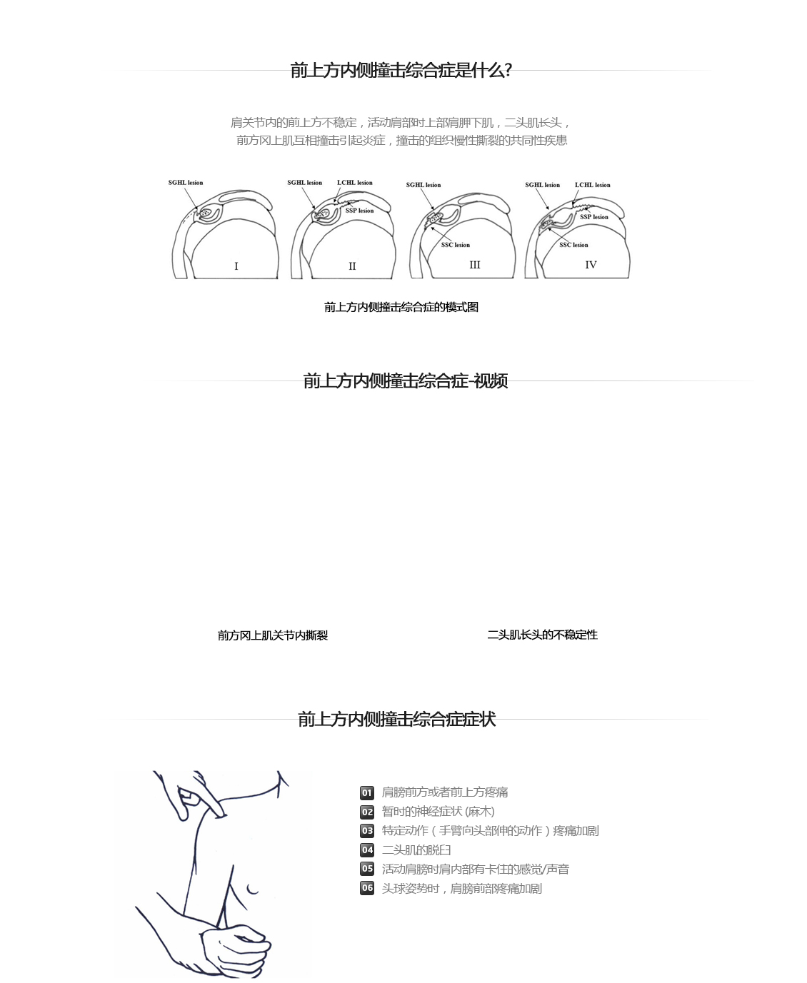 전상방내측충돌증후군