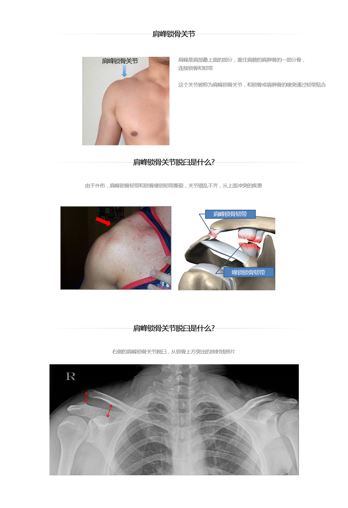 견봉쇄골 관절 탈구