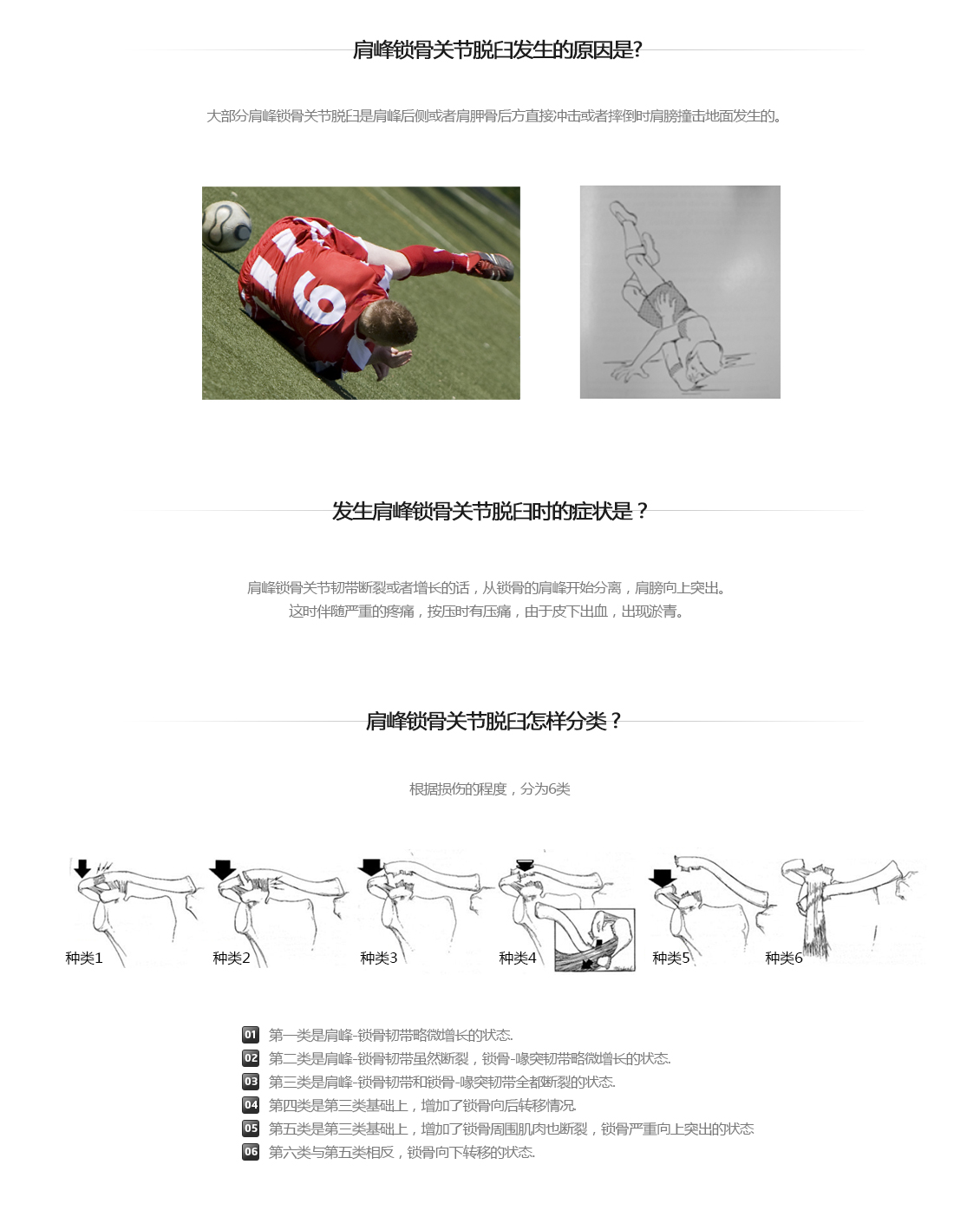 견봉쇄골 관절 탈구