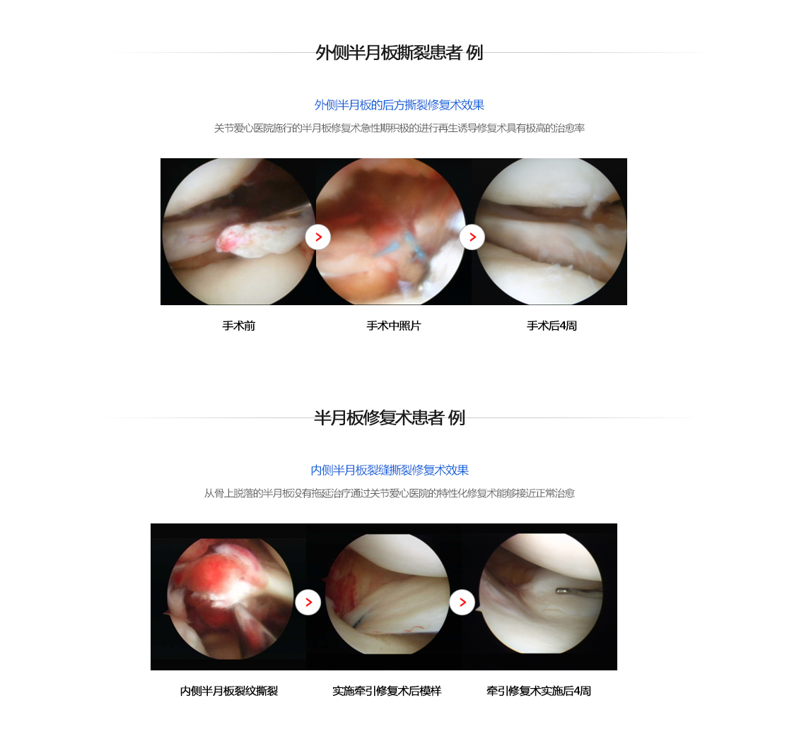 반월상연골파열