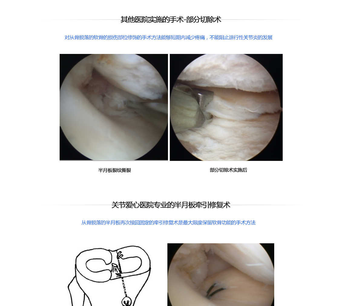 반월상연골 견열파열