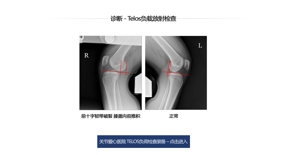 전방십자인대 파열