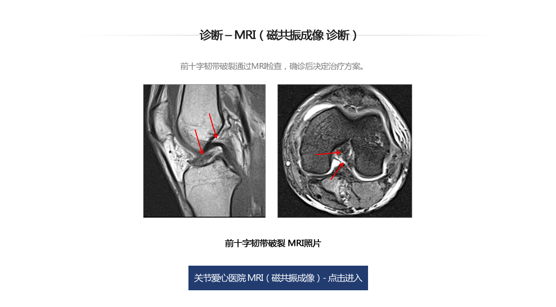 전방십자인대 파열