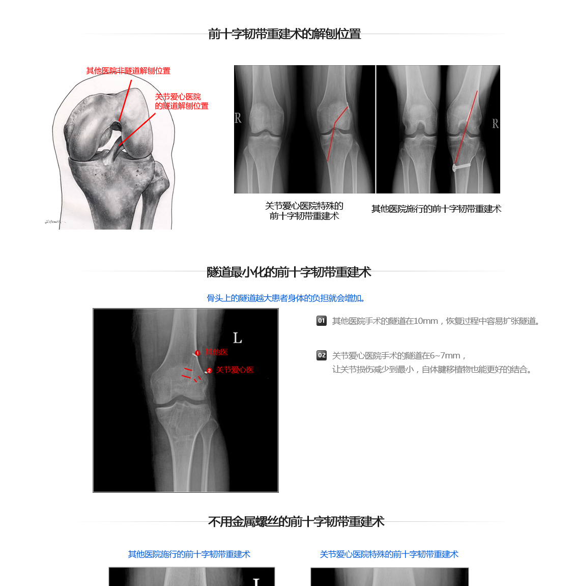 전방십자인대 파열