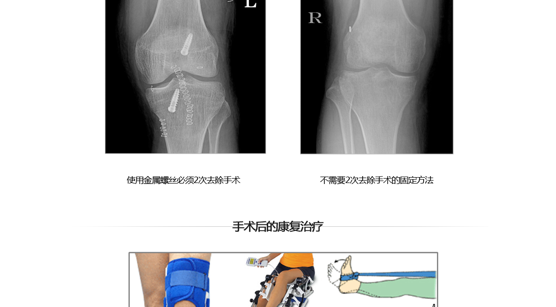 전방십자인대 파열