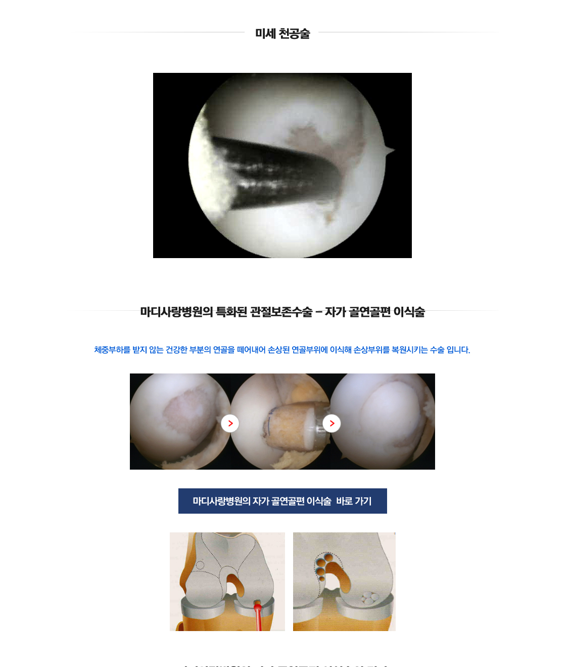 퇴행성관절염