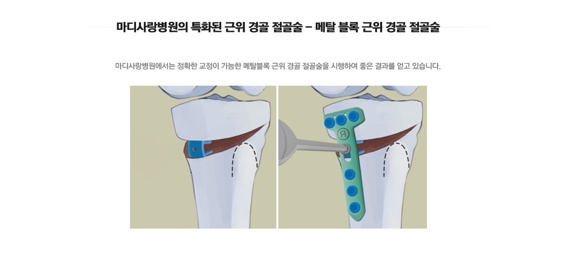 퇴행성관절염