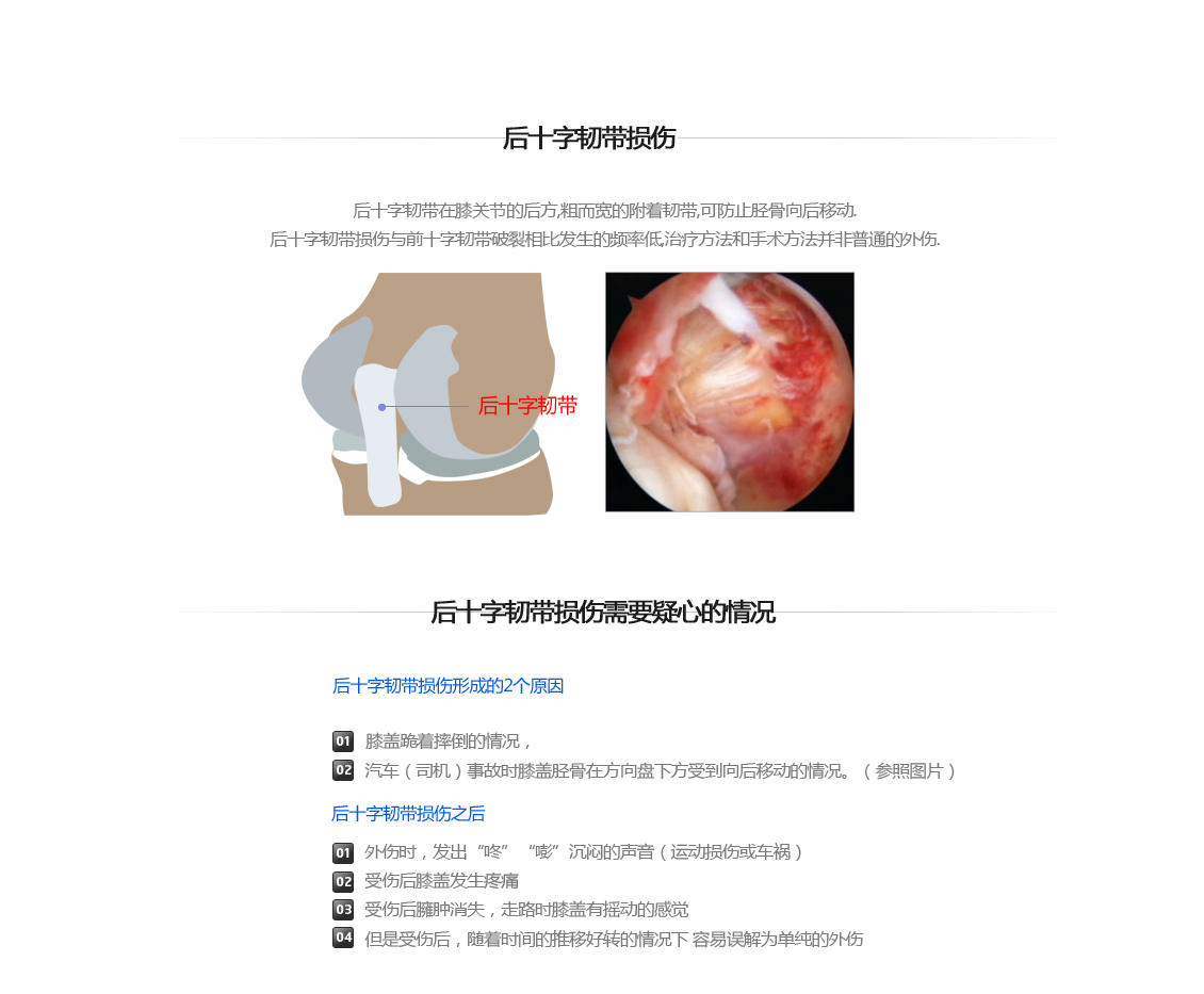 후방십자인대 파열