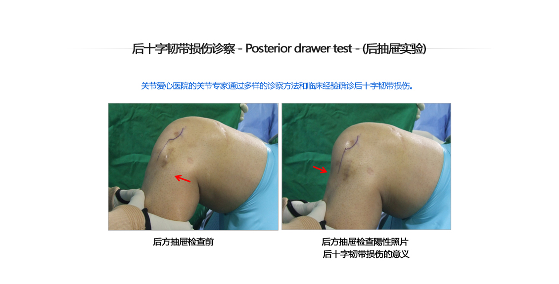 후방십자인대 파열