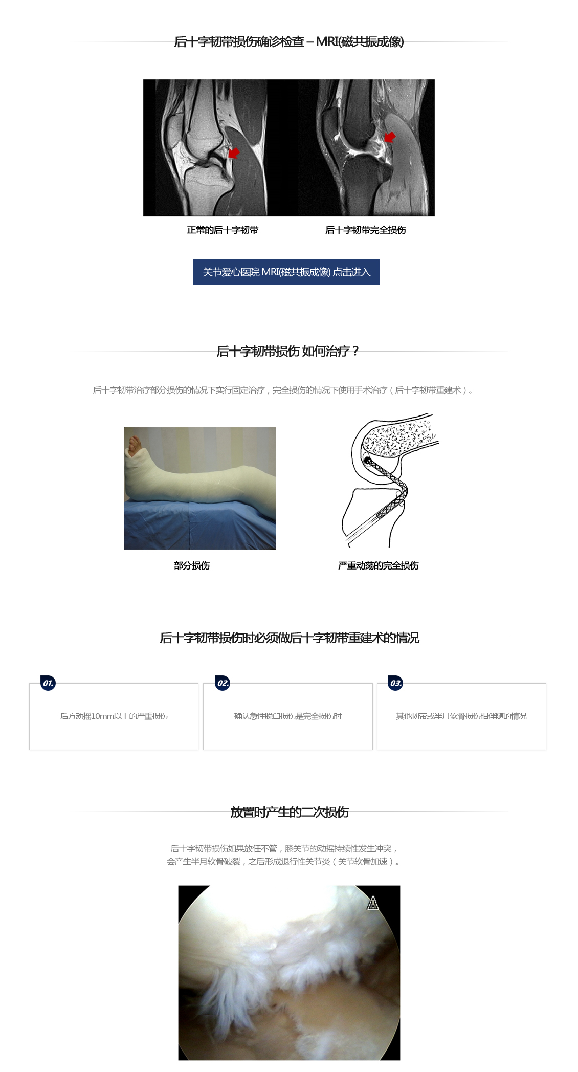 후방십자인대 파열