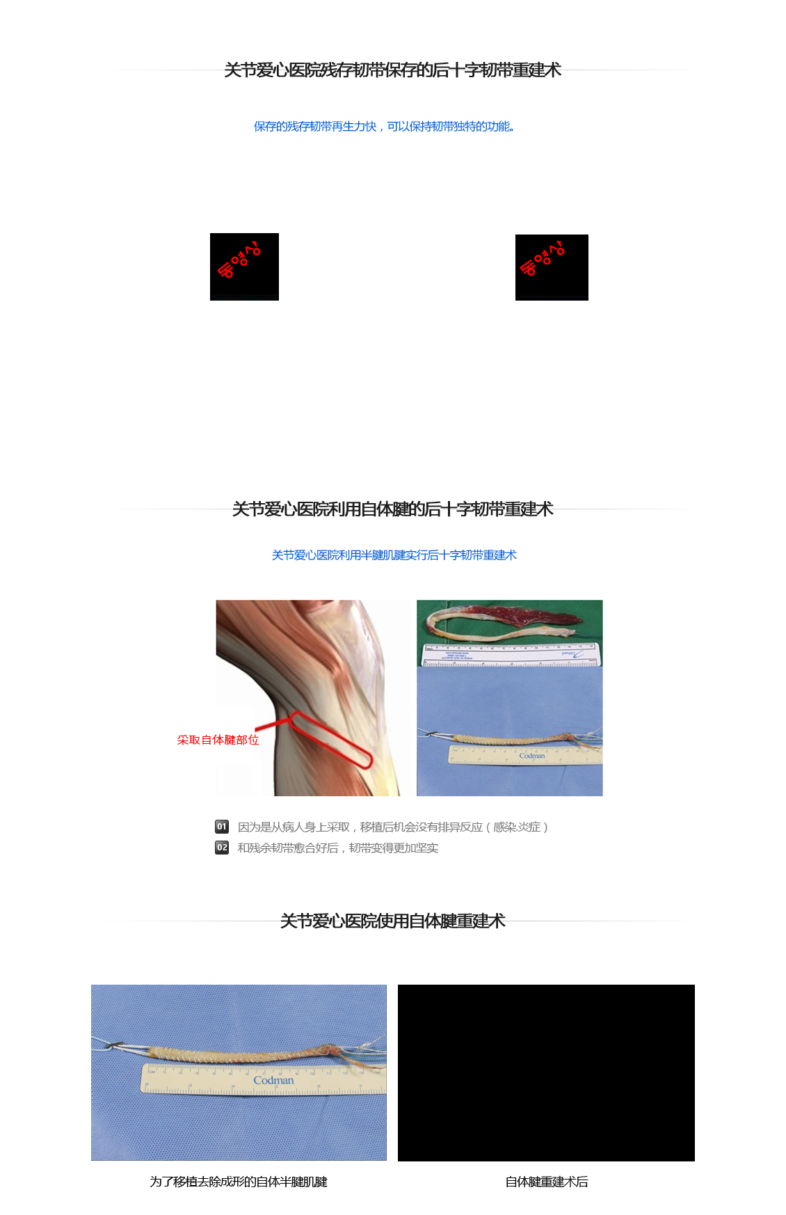 후방십자인대 파열