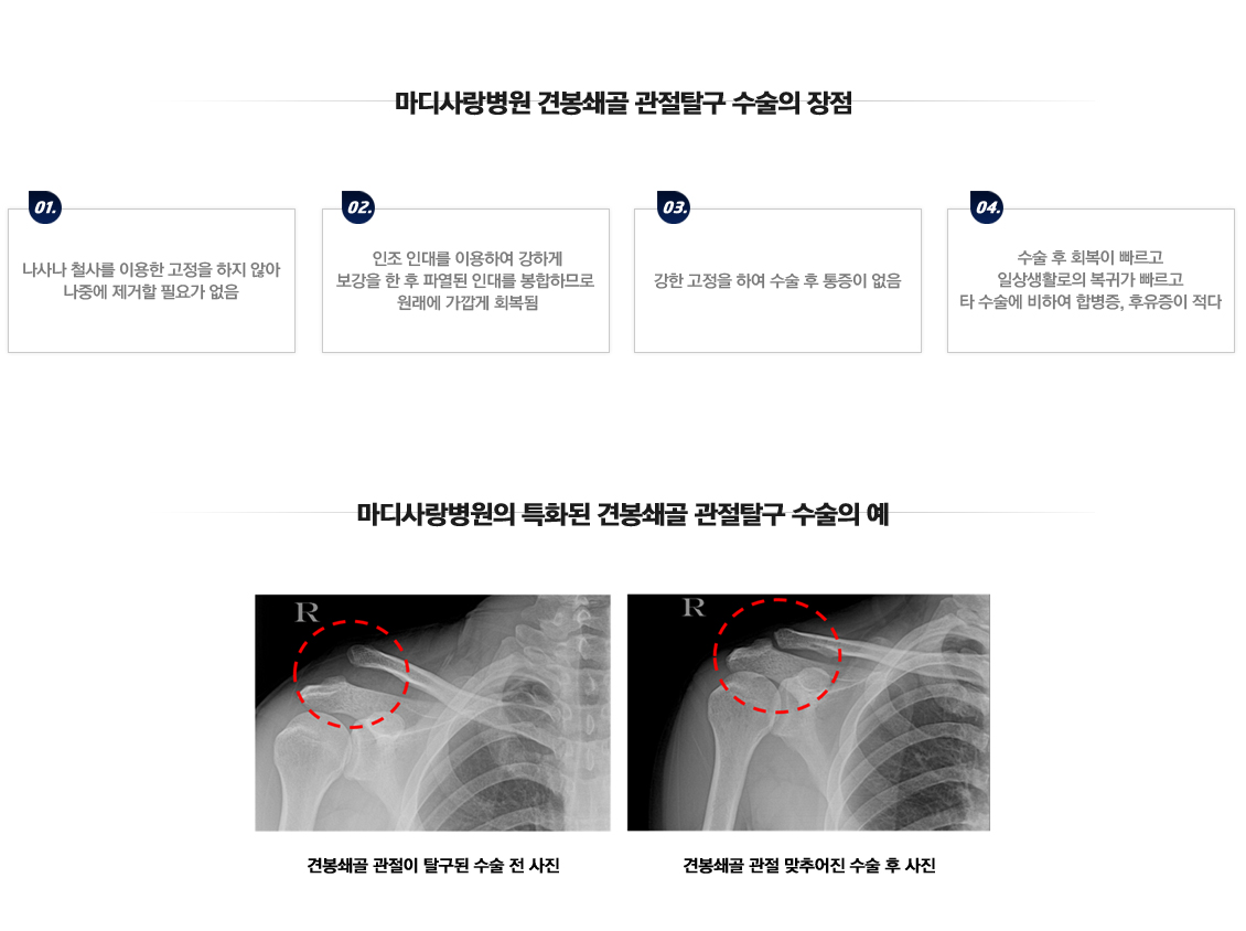 습관성 탈구