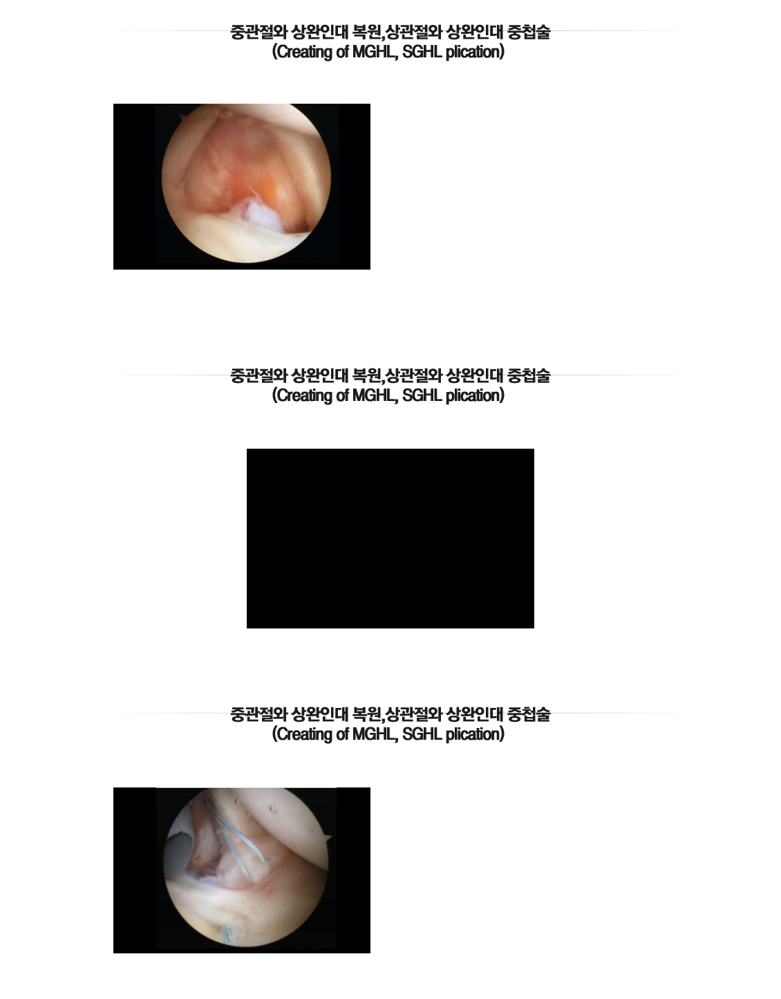 어깨 인공관절