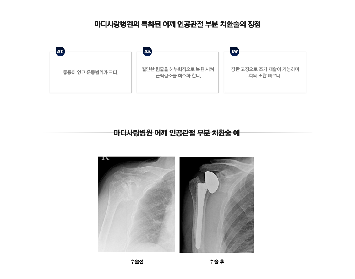 어깨 인공관절