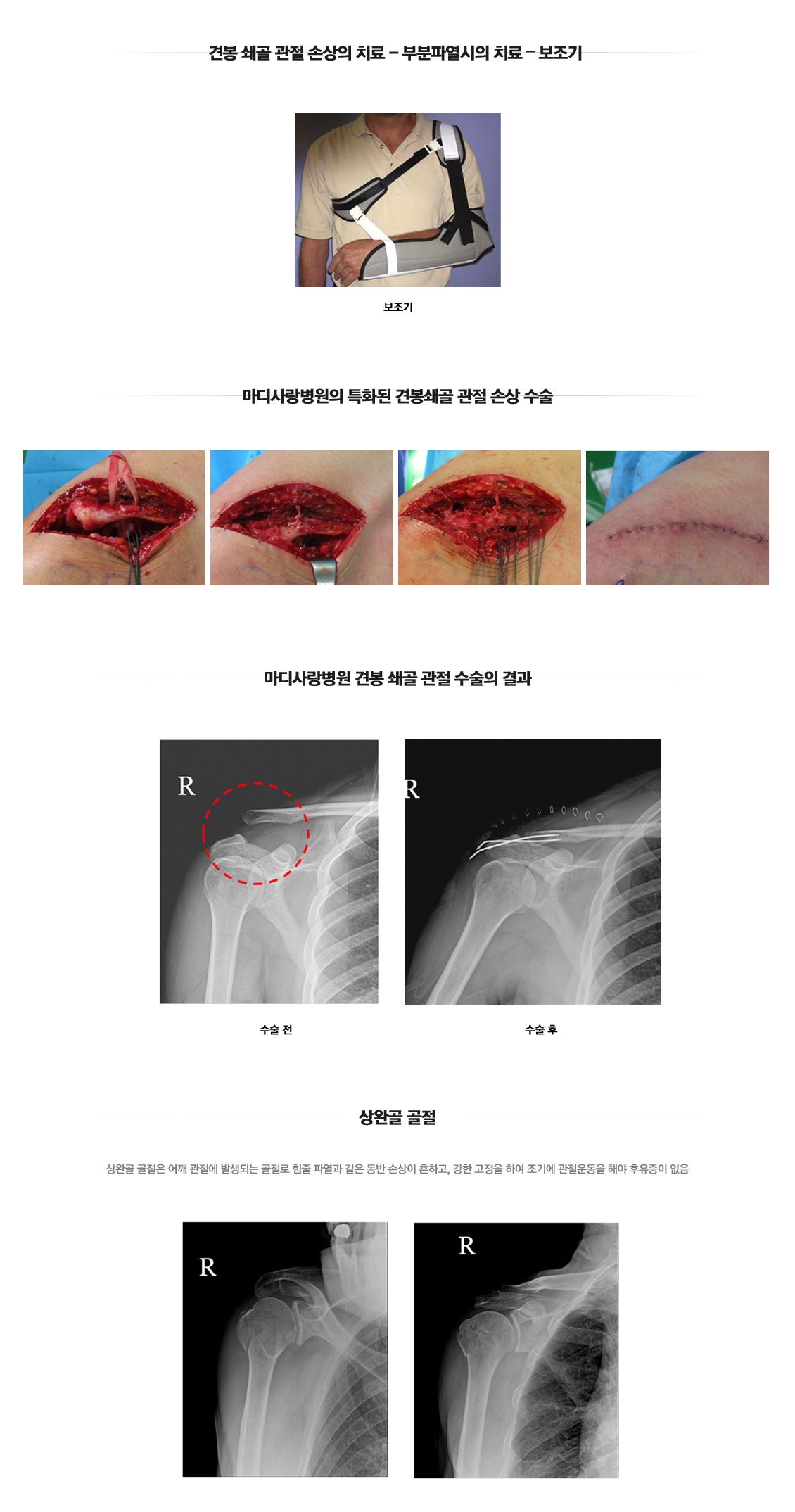 어깨 골절수술