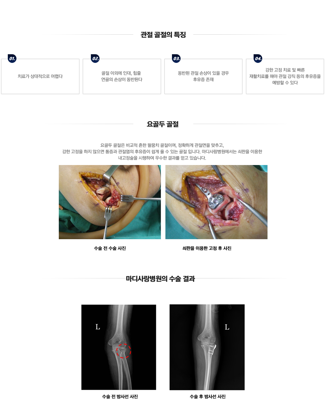 팔꿈치 골절수술 