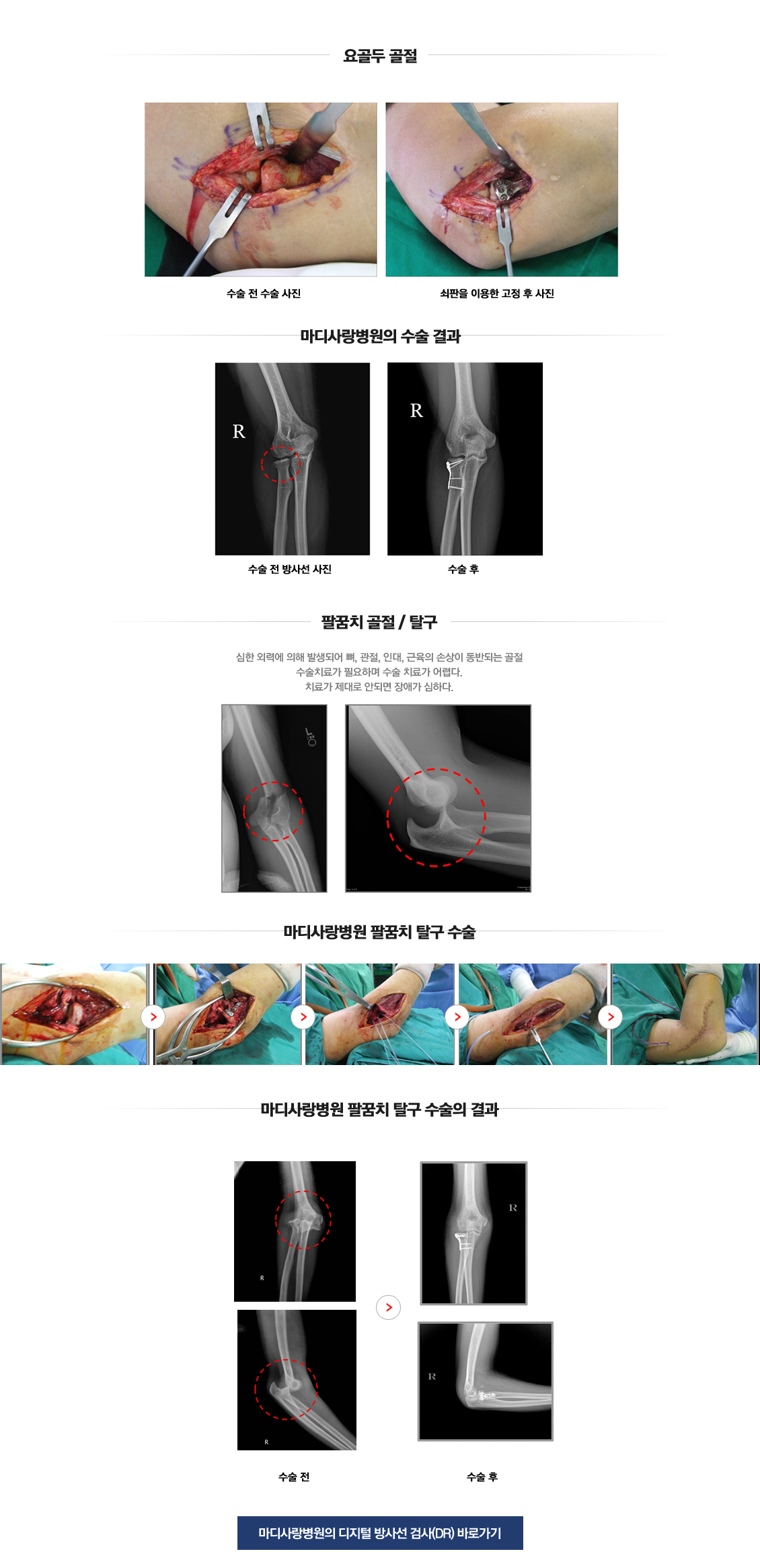 팔꿈치 골절수술