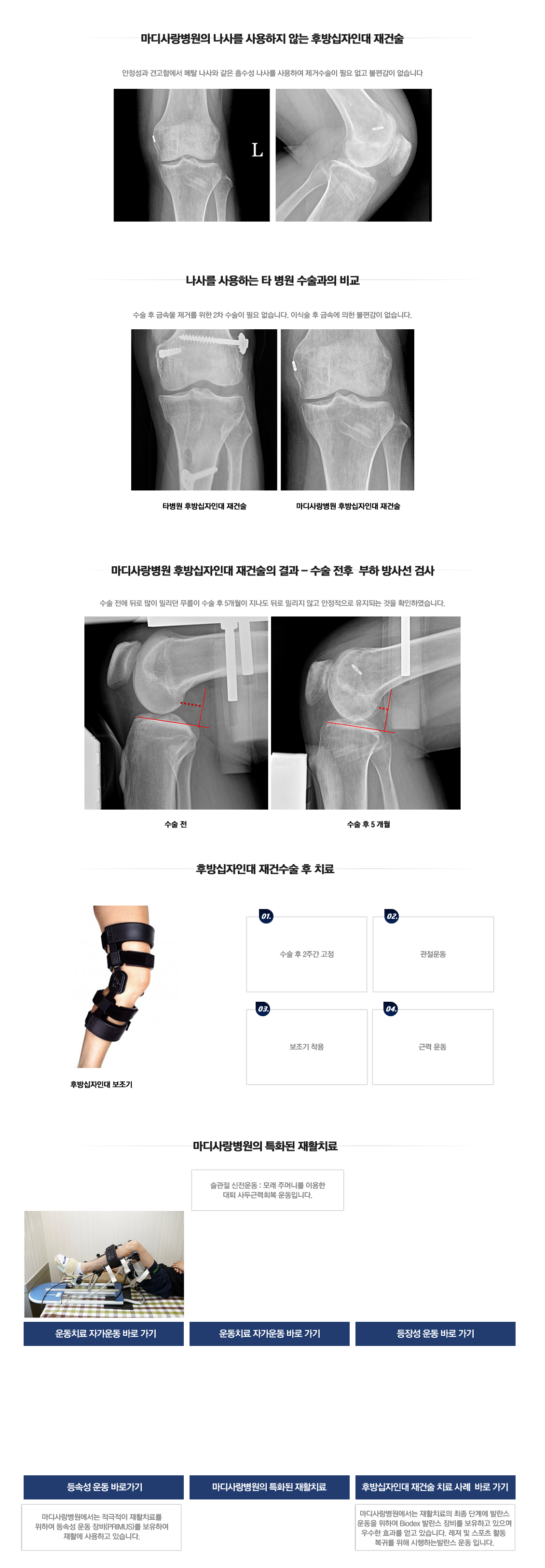 후방십자인대 재건술