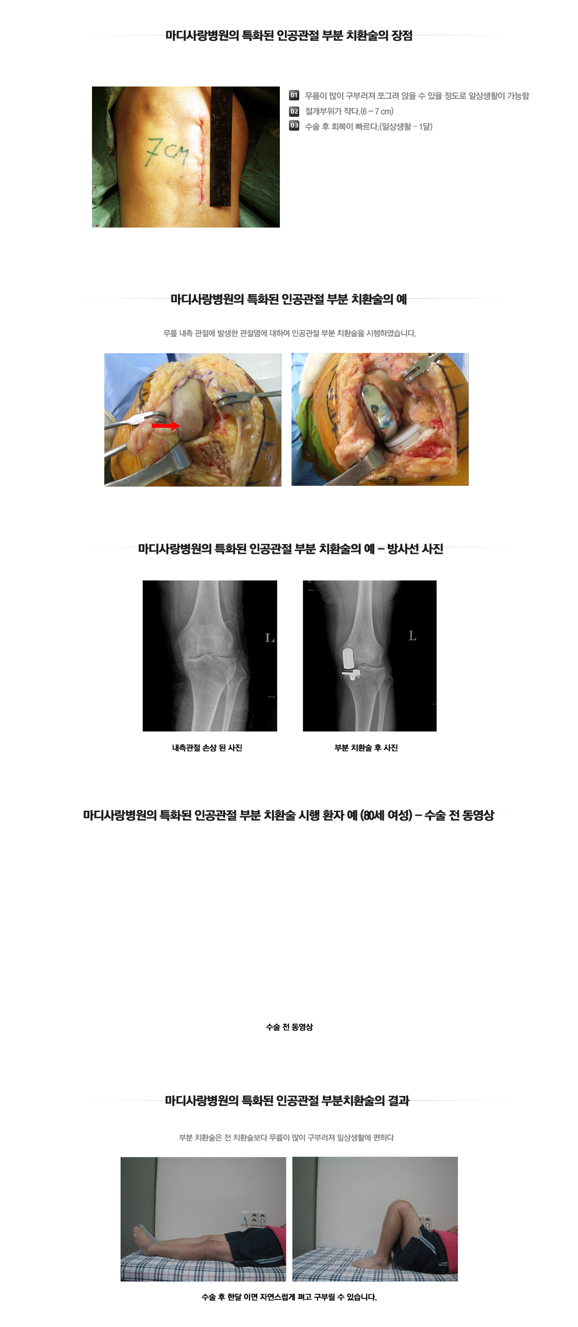 인공관절 부분치환술