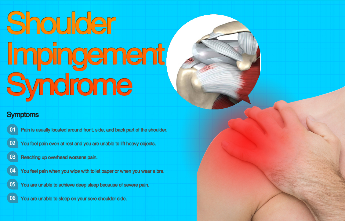 Impingement syndrome 