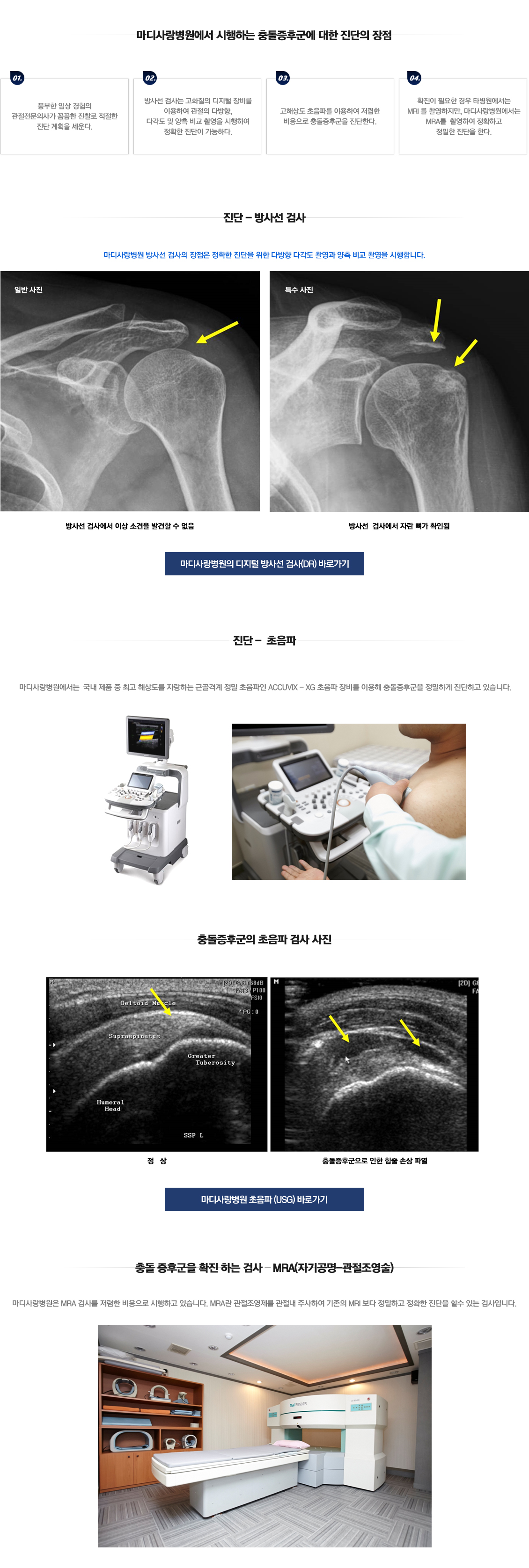 Impingement syndrome 