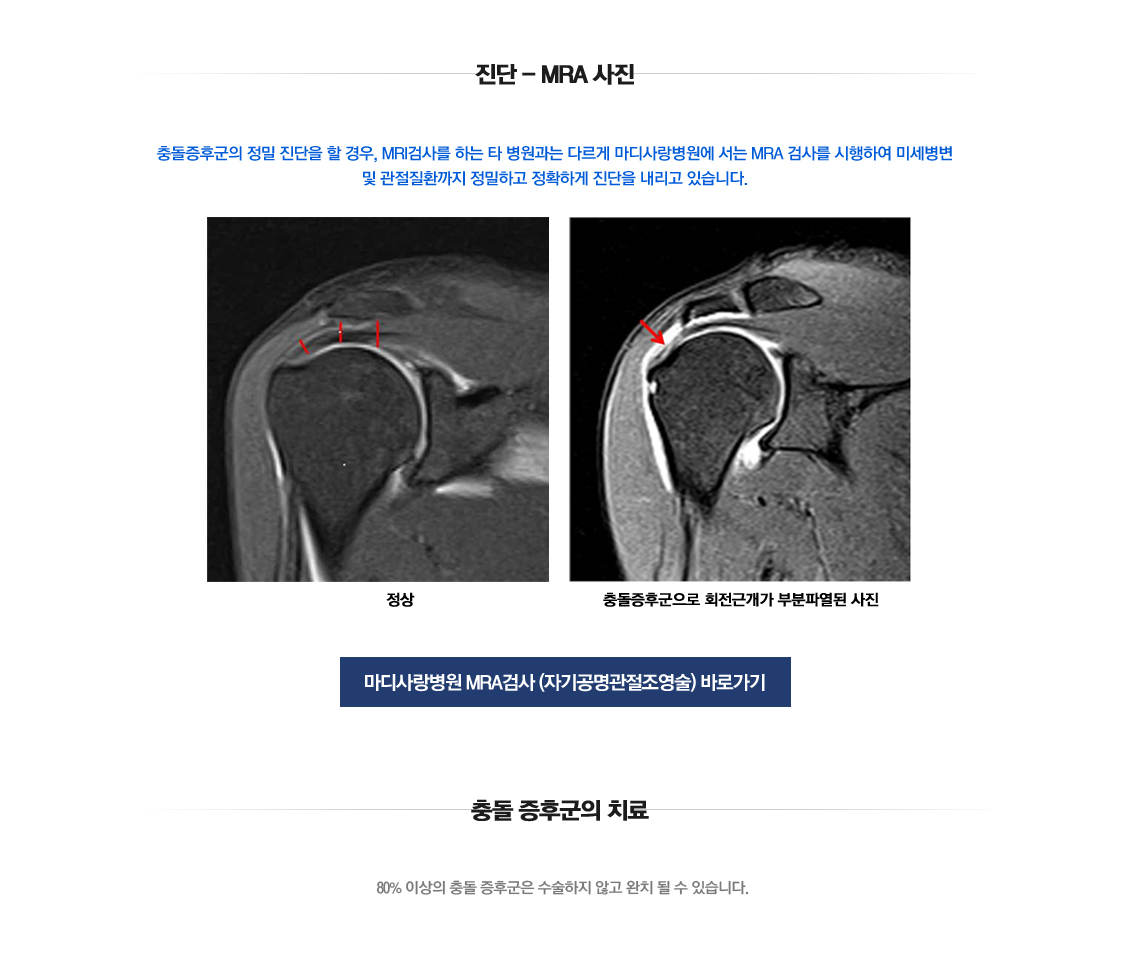 Impingement syndrome 