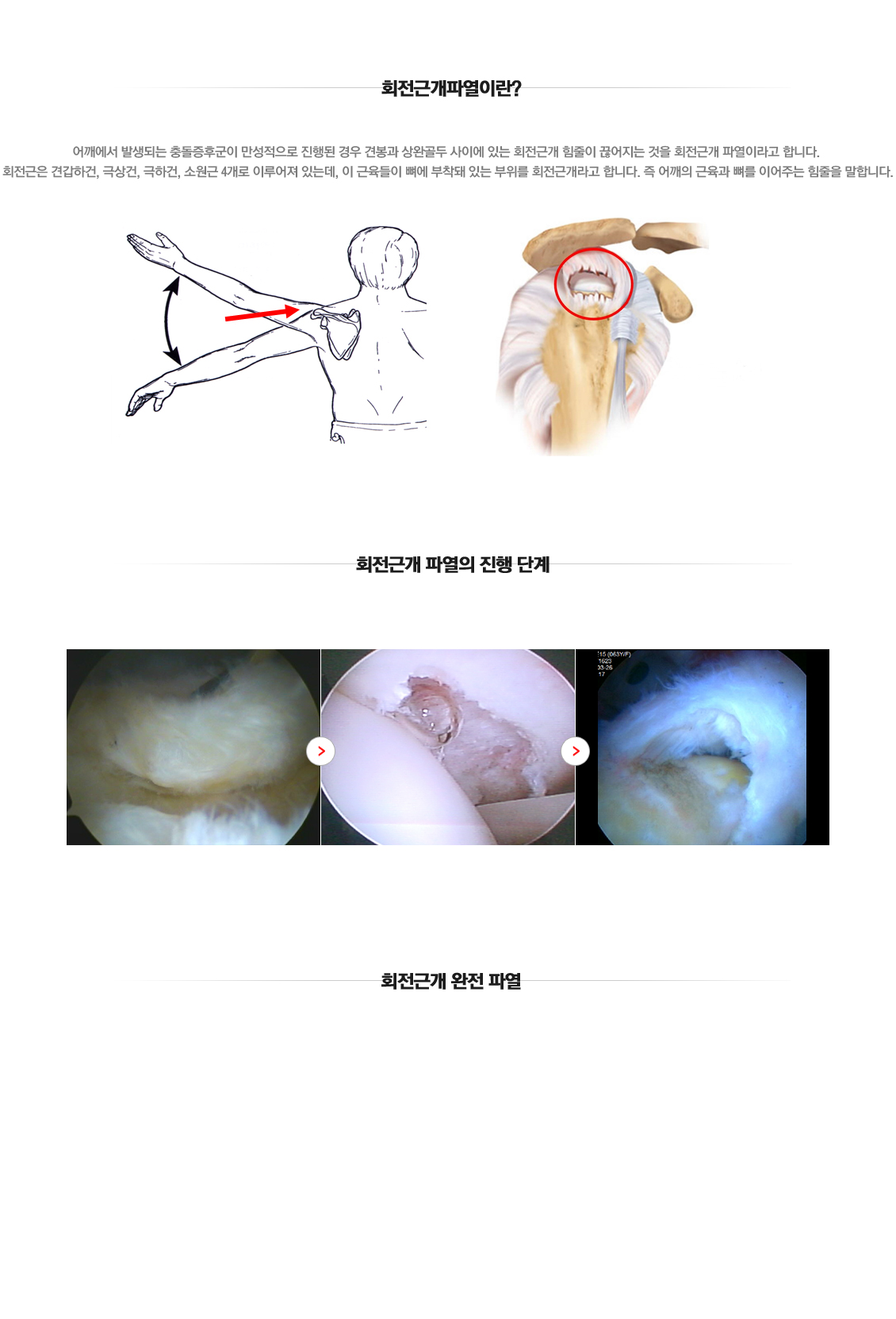 Rotator cuff tear