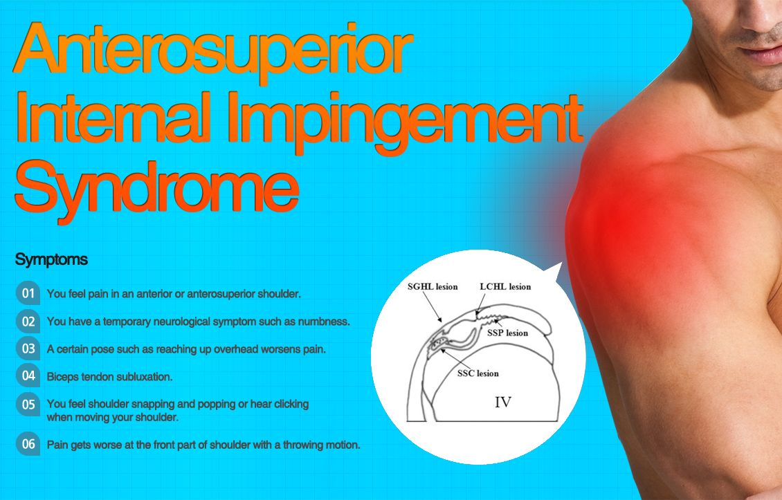 전상방내측Impingement syndrome 