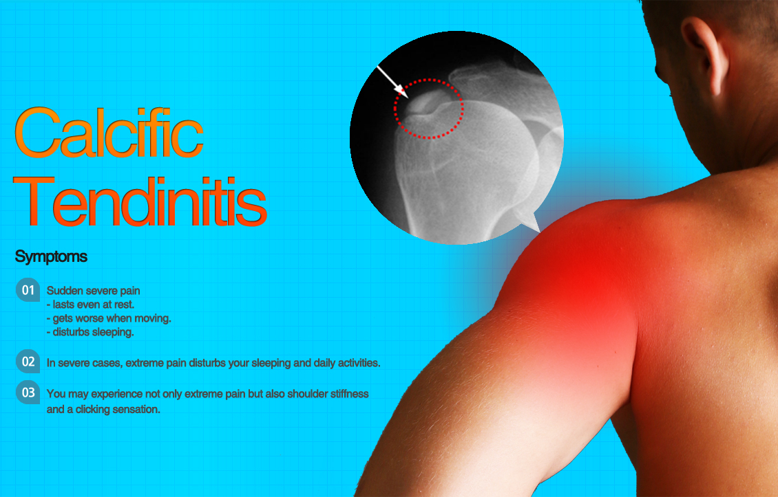 Calcific tendinitis