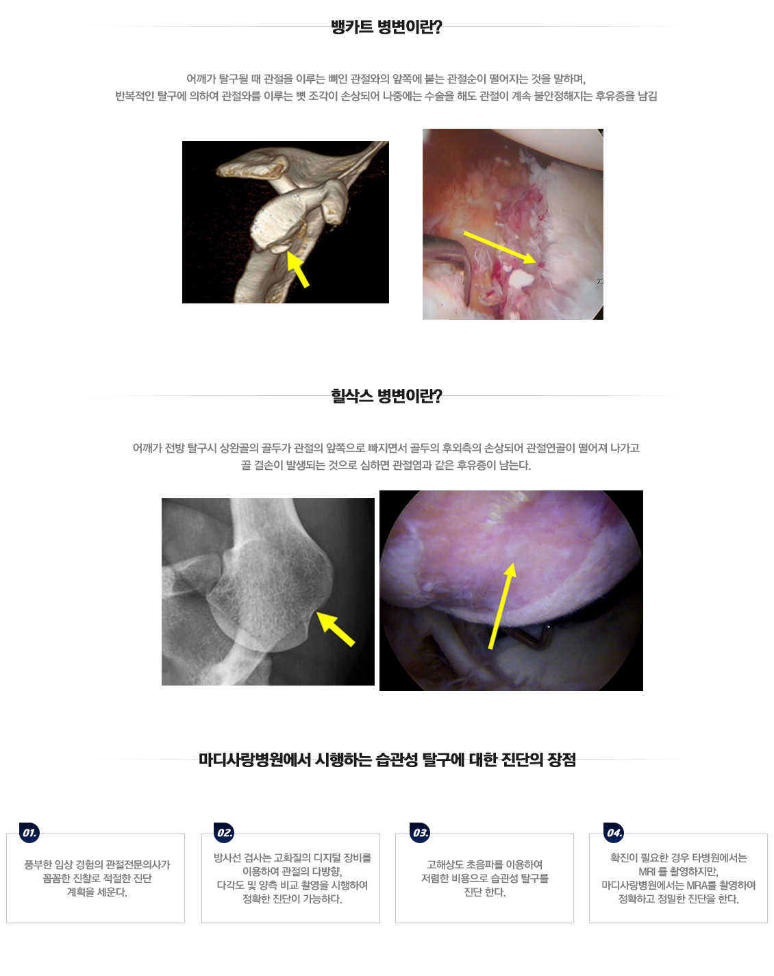 Recurrent dislocation