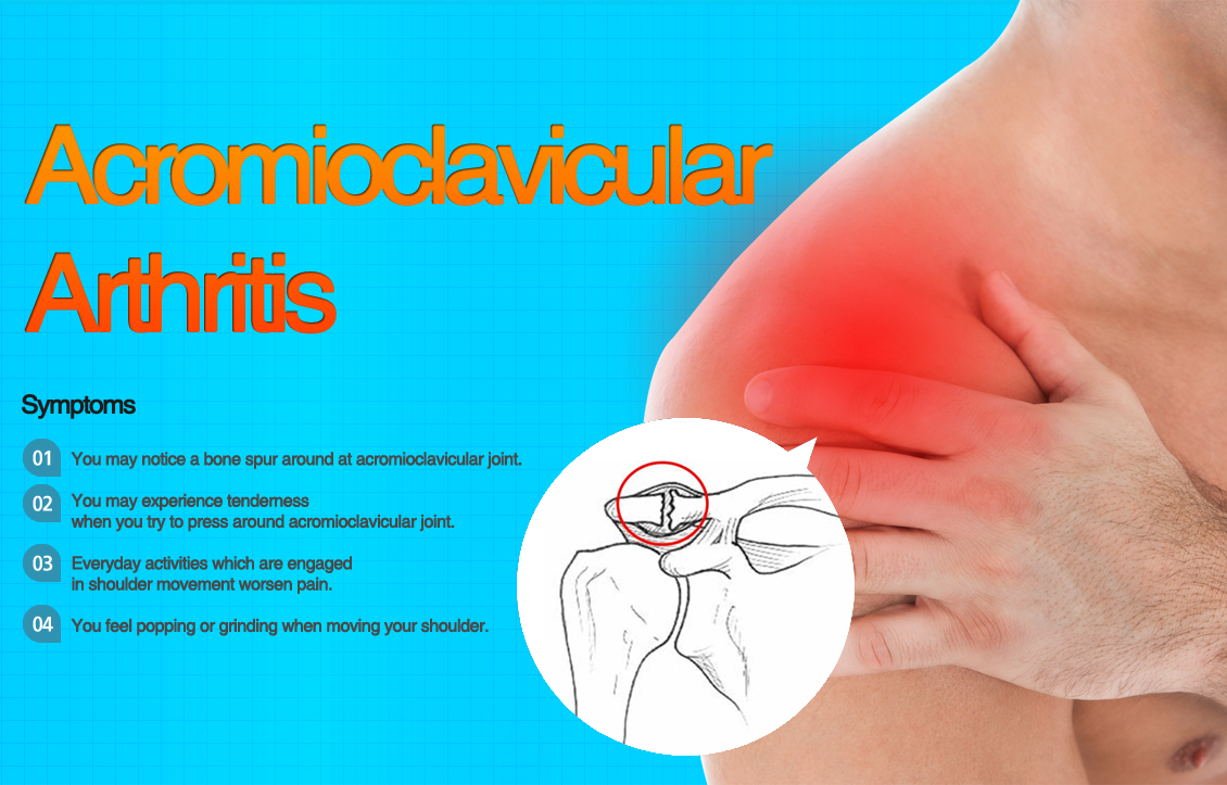 Acromioclavicular arthritis