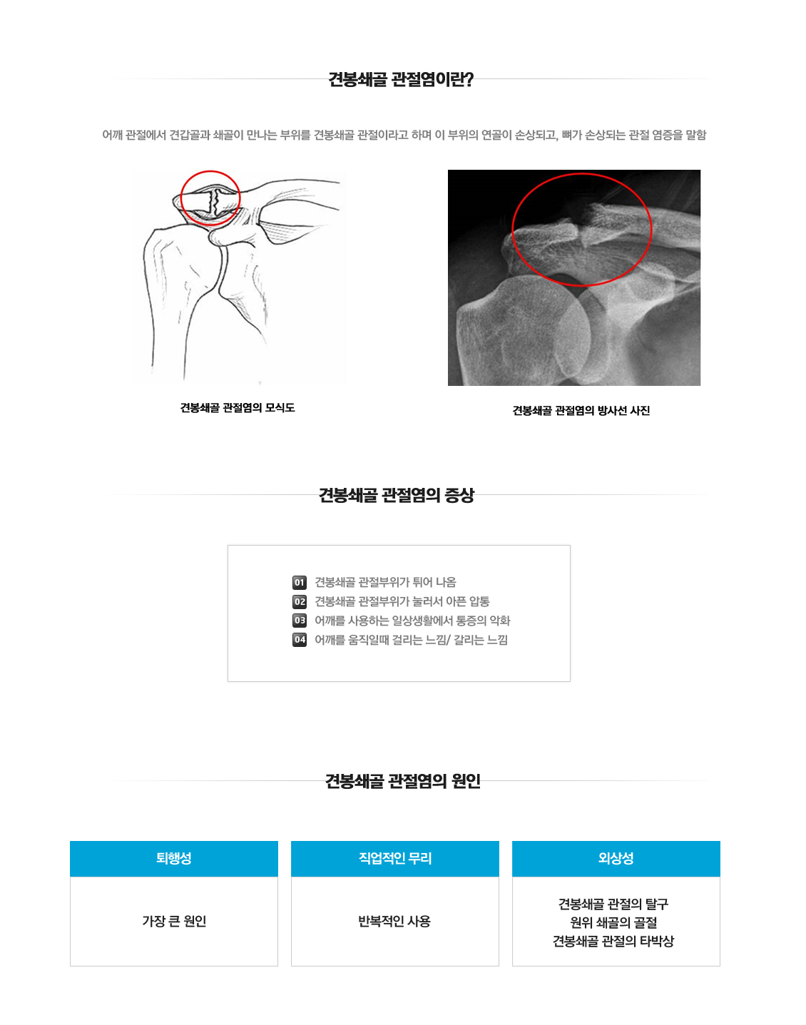 Acromioclavicular arthritis