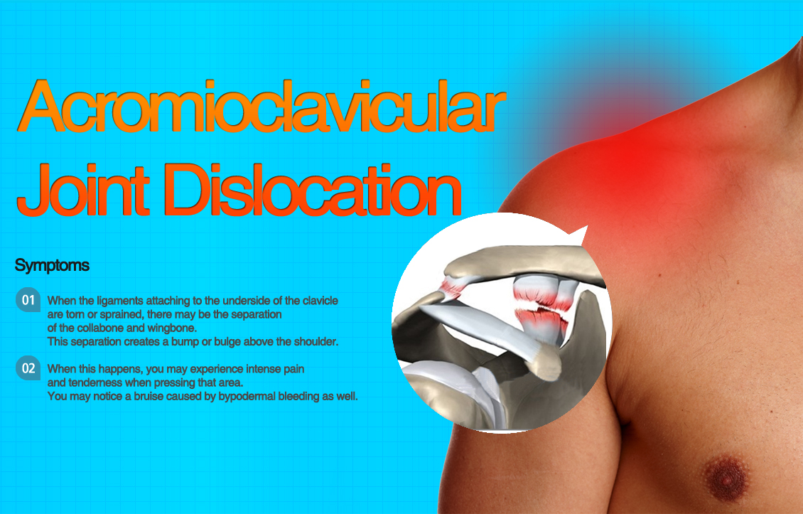 Acromioclavicular dislocation