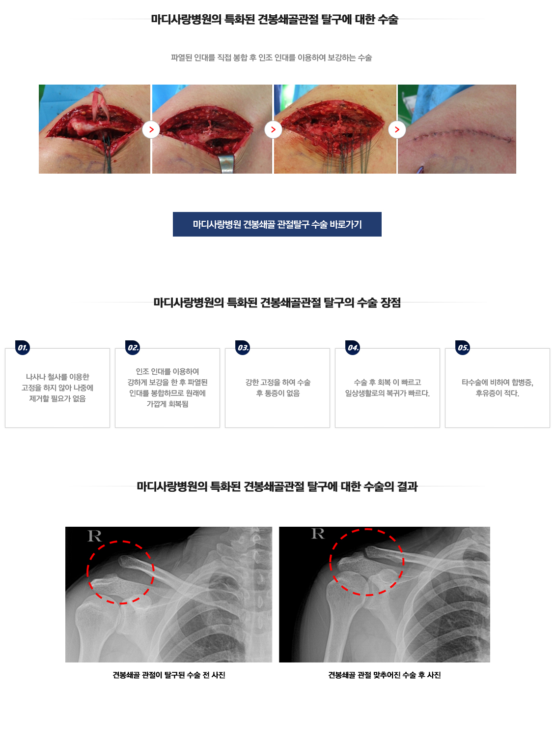 Acromioclavicular dislocation