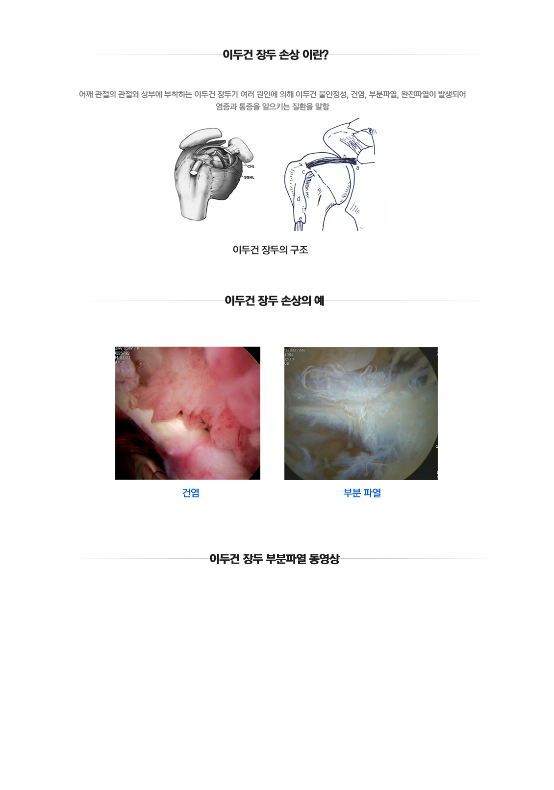 Injury of Long head biceps tendon 